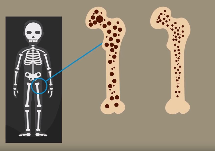 Osteoporosia